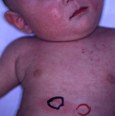 乳児のアトピー性皮膚炎　イメージ