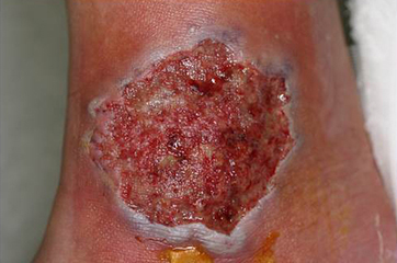 アレルギー性皮膚潰瘍　イメージ1