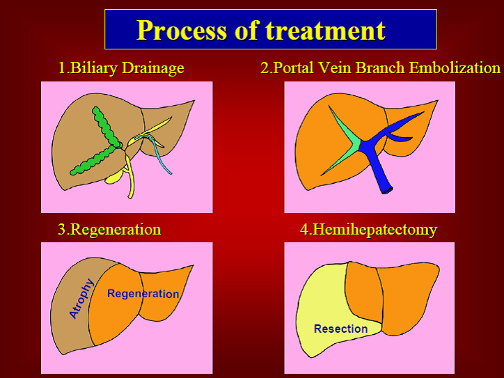 Process of treatment 門脈塞栓術の図
