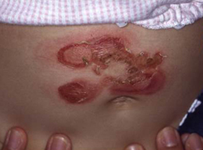 伝染性膿痂疹（とびひ）　イメージ1