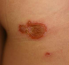 伝染性膿痂疹（とびひ）　イメージ2