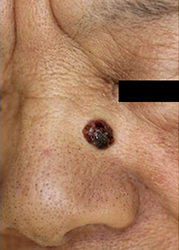 鼻の基底細部癌（手術前）　イメージ