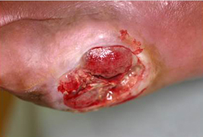 左足の小指の皮膚潰瘍に細菌感染を起こし足が腫れた　イメージ
