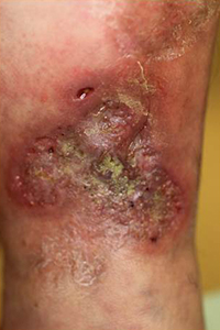 アレルギー性皮膚潰瘍　イメージ2