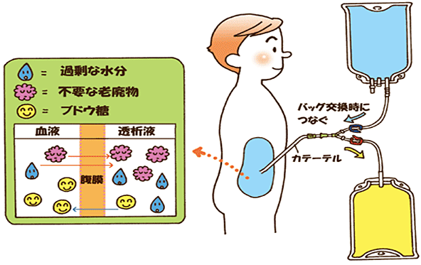 腹膜透析（PD）