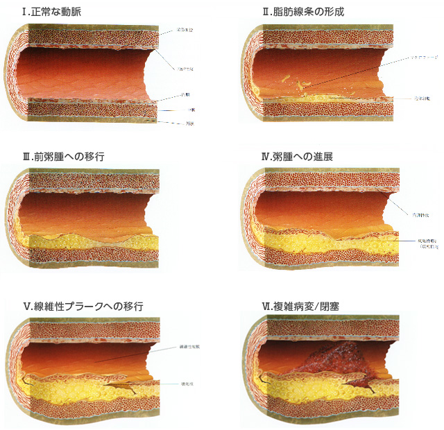 動脈硬化を起こしている血管イメージ図