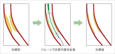 バルーン形成術　イメージ図