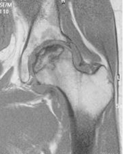 大腿骨頭壊死症のMRI検査レントゲン画像