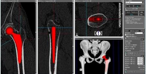 三次元術前計画 レントゲン画像