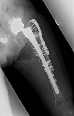 骨バンクからの同種骨移植を併用した人工股関節再置換術 レントゲン画像