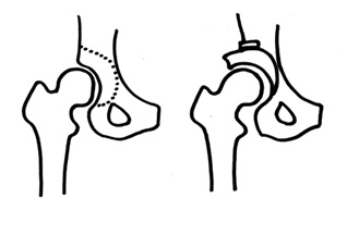 寛骨臼回転骨切りのシェーマ　イメージ図