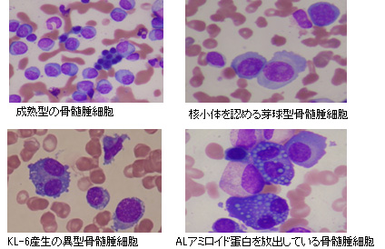 骨髄腫細胞のギムザ染色標本イメージ画像