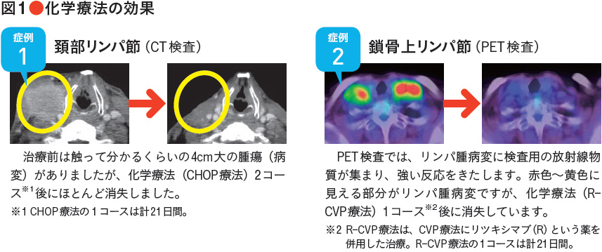 図1　化学療法の効果