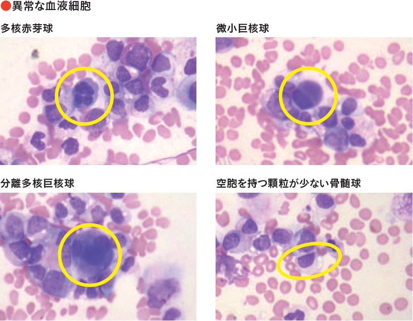 異常な血液細胞写真