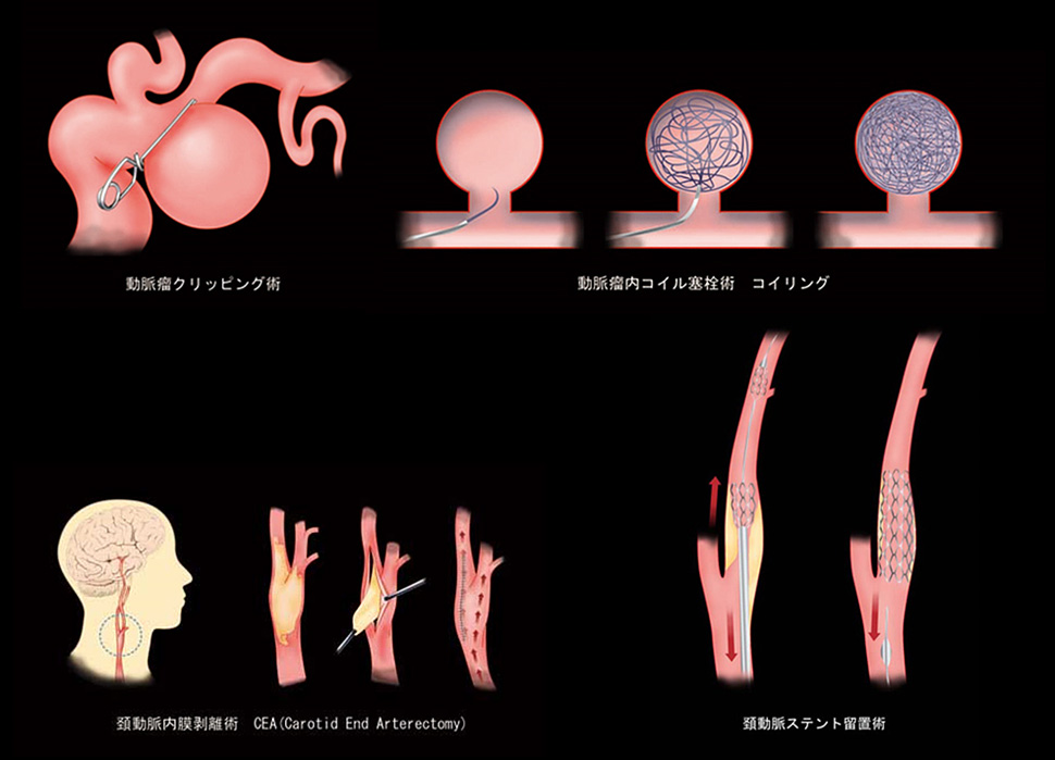 動脈瘤クリッピング術、動脈瘤内コイル塞栓術コイリング、頸動脈内膜剥離術、頸動脈ステント留置術