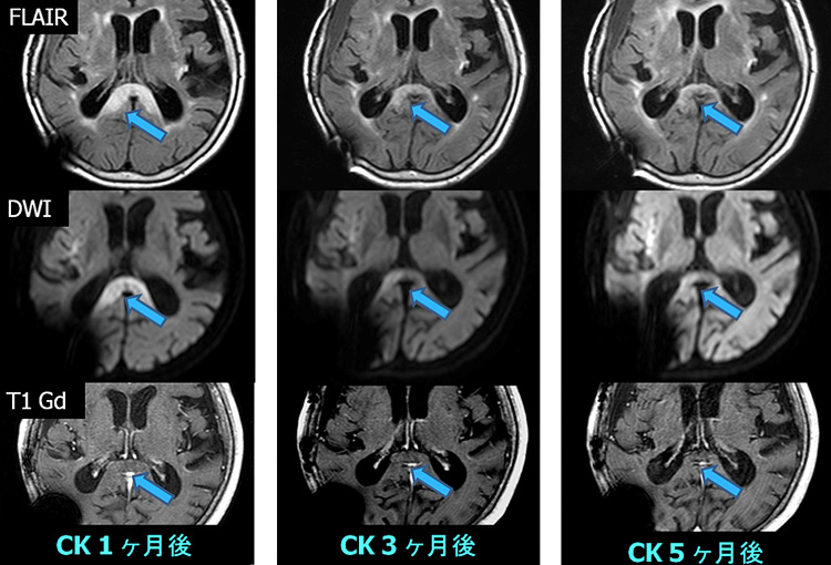 サイバーナイフ治療後のMRI所見：矢印の造影されない病変が徐々に縮小イメージ