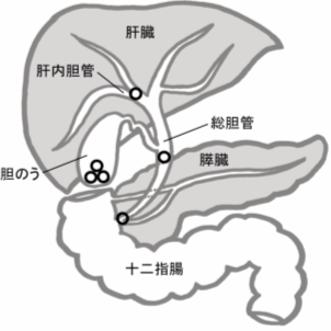 胆石イラスト