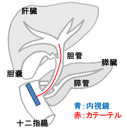 ERCP　イメージ図1