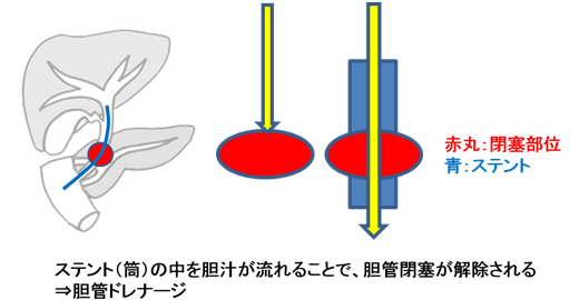 ERCP　イメージ図3