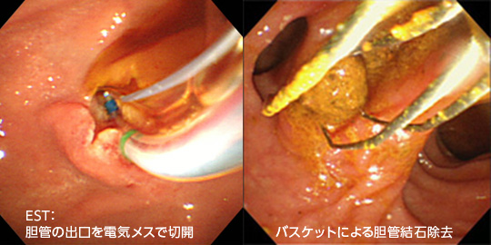 内視鏡的胆管結石除去術画像