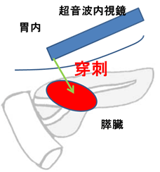 EUS-FNAのイメージ図