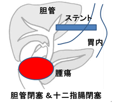 EUS-BDのイメージ図：EUS-HGSの場合