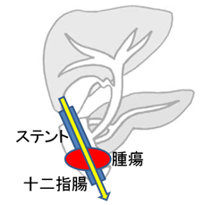内視鏡的消化管ステント留置術 イメージ図