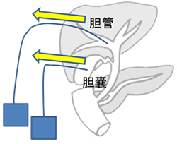 PTBD, PTGBDのイメージ図