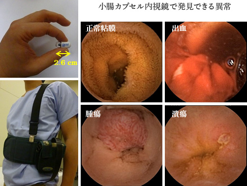 小腸カプセル内視鏡で発見できる異常