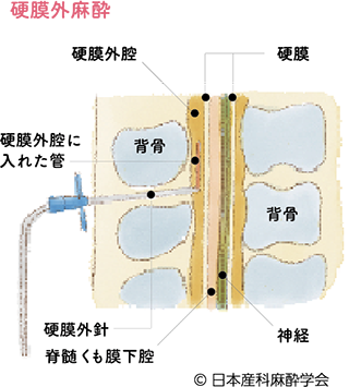 硬膜外麻酔