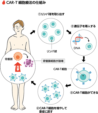 CAR-T細胞療法の仕組み
