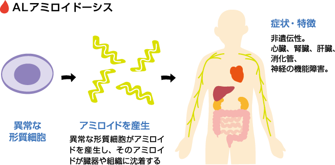 ALアミロイドーシス