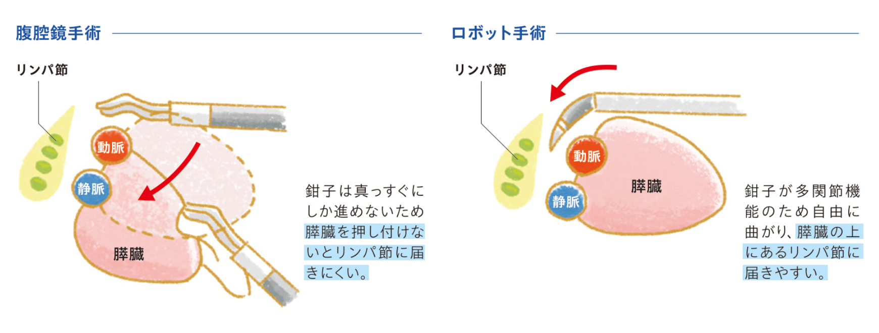 腹腔鏡手術とロボット手術のリンパ節到達の違い